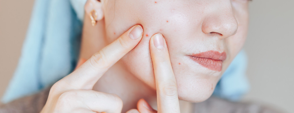 What You Need To Know About Acne Abi Dermaceuticals